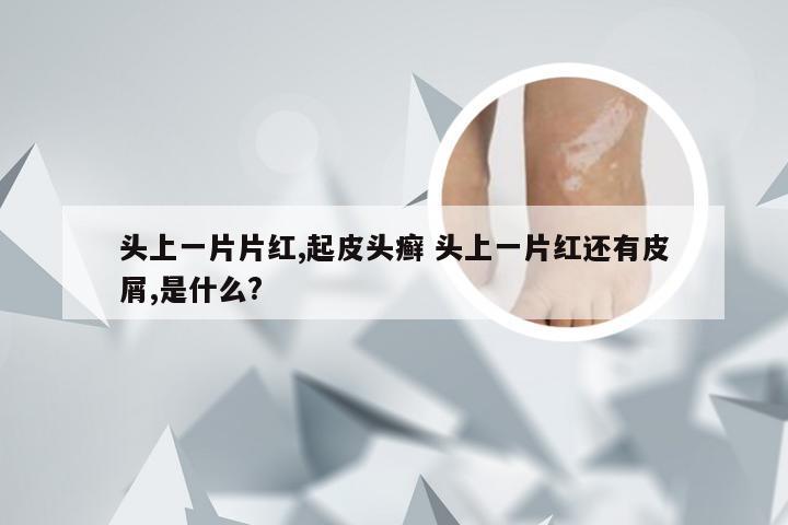 头上一片片红,起皮头癣 头上一片红还有皮屑,是什么?