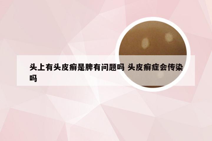 头上有头皮癣是脾有问题吗 头皮癣症会传染吗