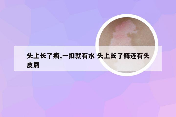 头上长了癣,一扣就有水 头上长了藓还有头皮屑