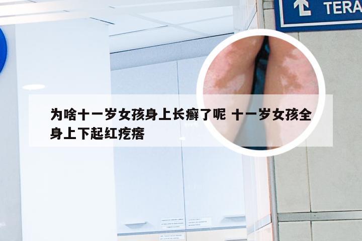 为啥十一岁女孩身上长癣了呢 十一岁女孩全身上下起红疙瘩
