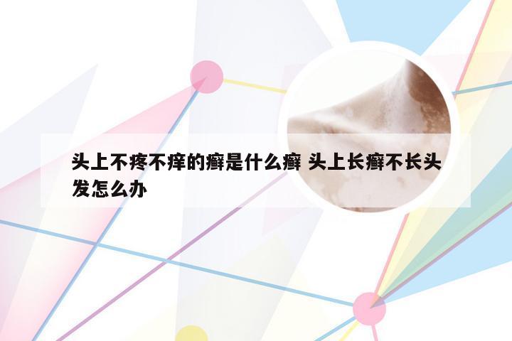 头上不疼不痒的癣是什么癣 头上长癣不长头发怎么办