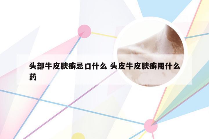 头部牛皮肤癣忌口什么 头皮牛皮肤癣用什么药