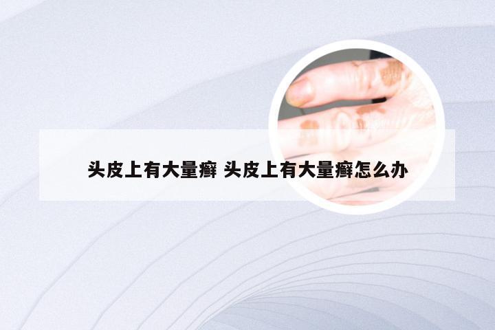 头皮上有大量癣 头皮上有大量癣怎么办
