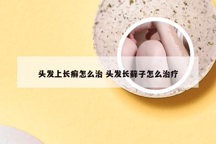 头发上长癣怎么治 头发长藓子怎么治疗