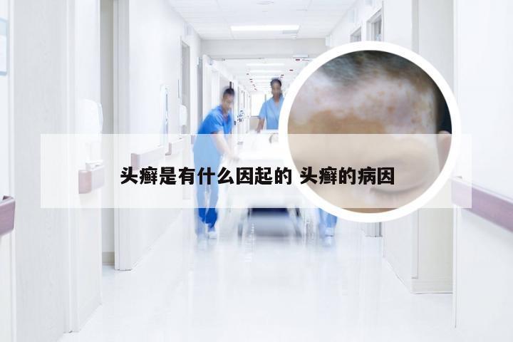 头癣是有什么因起的 头癣的病因