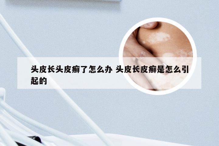 头皮长头皮癣了怎么办 头皮长皮癣是怎么引起的