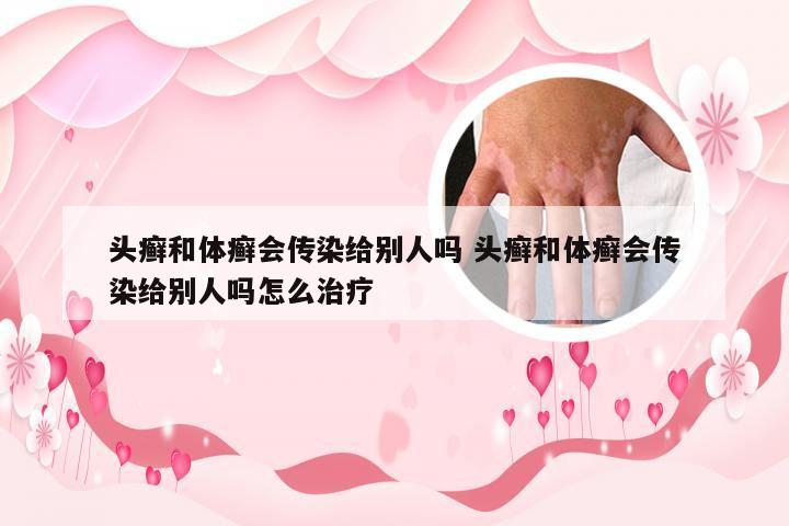头癣和体癣会传染给别人吗 头癣和体癣会传染给别人吗怎么治疗