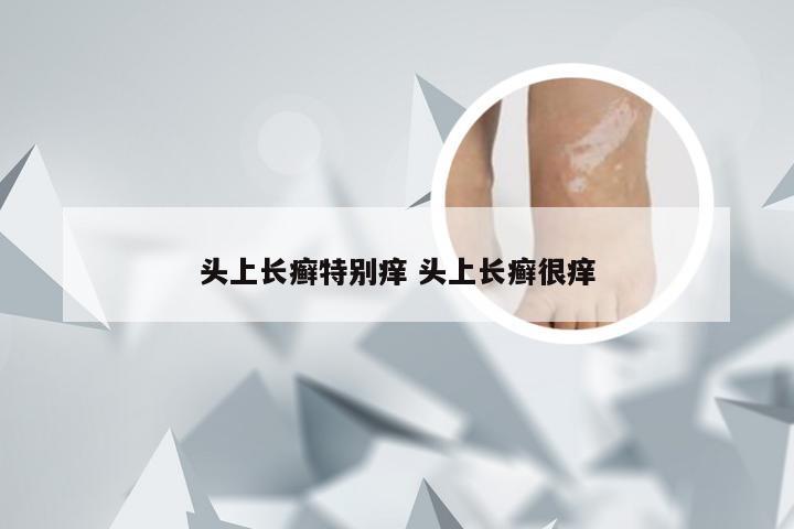 头上长癣特别痒 头上长癣很痒