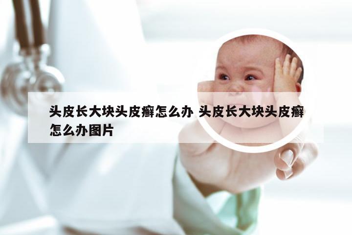 头皮长大块头皮癣怎么办 头皮长大块头皮癣怎么办图片