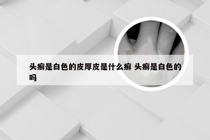 头癣是白色的皮厚皮是什么癣 头癣是白色的吗