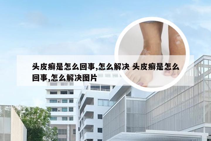 头皮癣是怎么回事,怎么解决 头皮癣是怎么回事,怎么解决图片