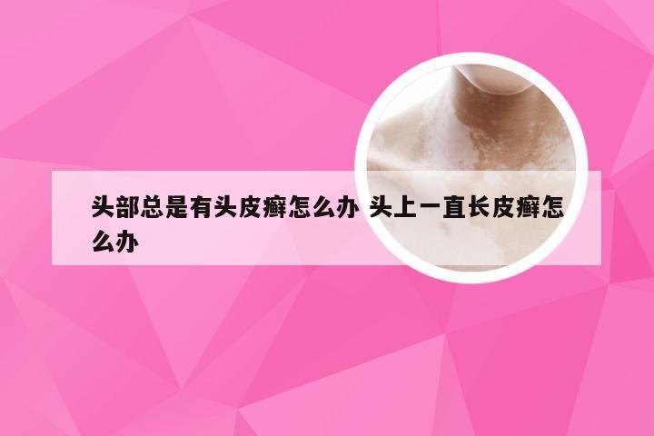 头部总是有头皮癣怎么办 头上一直长皮癣怎么办