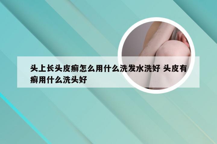 头上长头皮癣怎么用什么洗发水洗好 头皮有癣用什么洗头好
