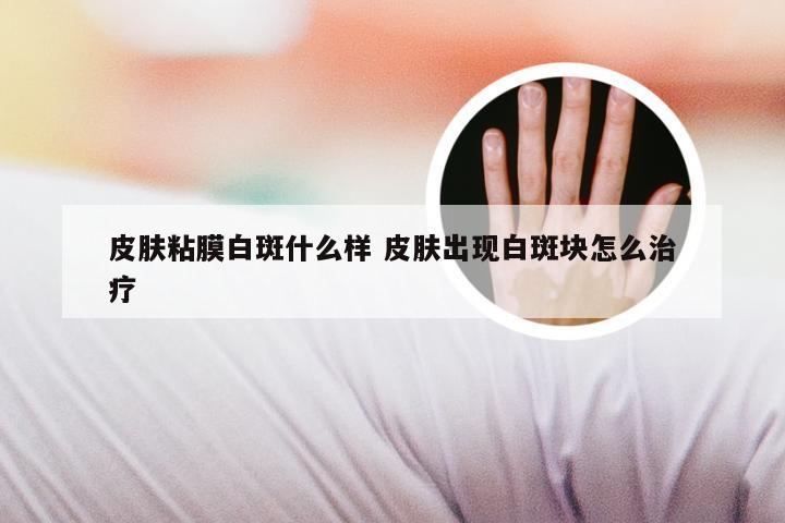 皮肤粘膜白斑什么样 皮肤出现白斑块怎么治疗