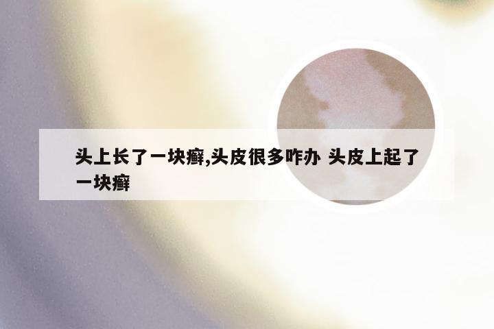 头上长了一块癣,头皮很多咋办 头皮上起了一块癣