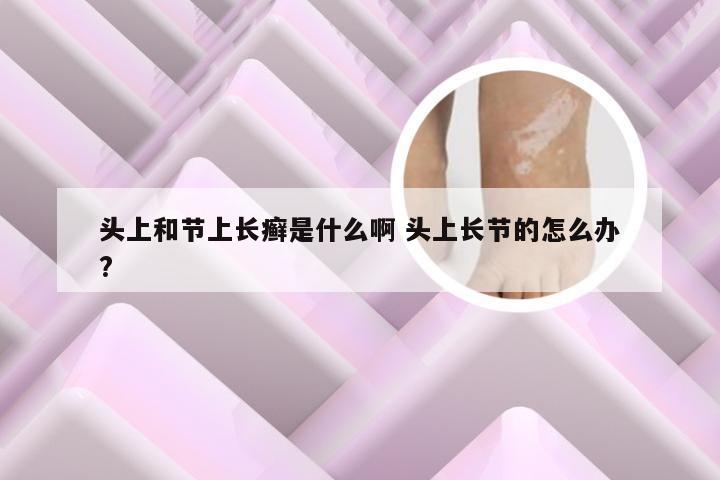 头上和节上长癣是什么啊 头上长节的怎么办?