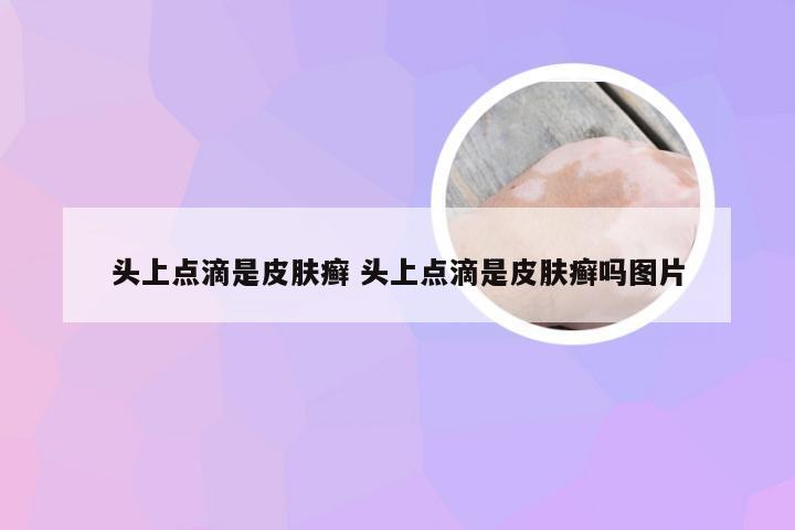 头上点滴是皮肤癣 头上点滴是皮肤癣吗图片