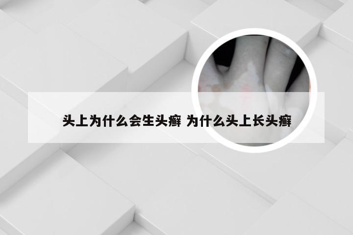 头上为什么会生头癣 为什么头上长头癣