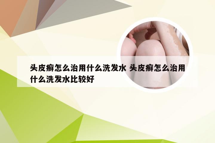 头皮癣怎么治用什么洗发水 头皮癣怎么治用什么洗发水比较好