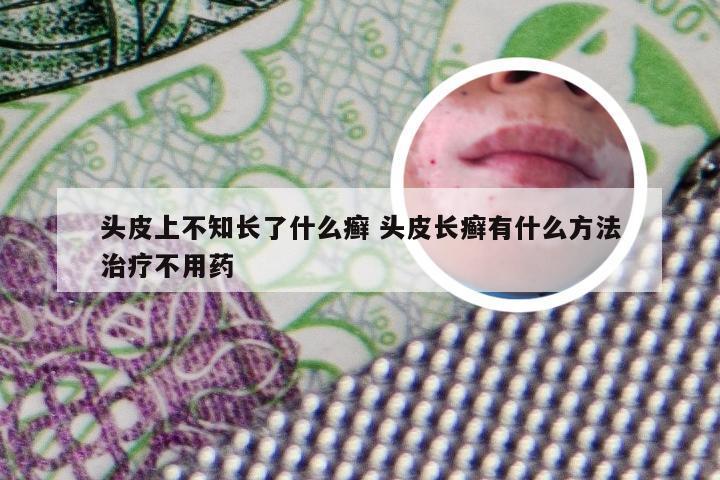 头皮上不知长了什么癣 头皮长癣有什么方法治疗不用药