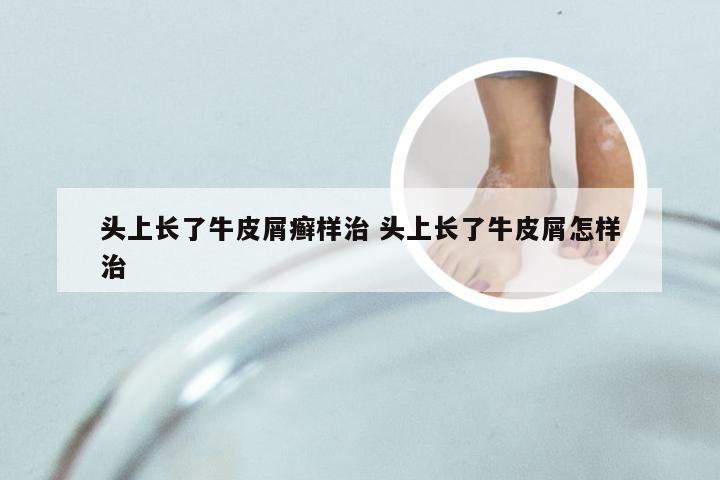 头上长了牛皮屑癣样治 头上长了牛皮屑怎样治