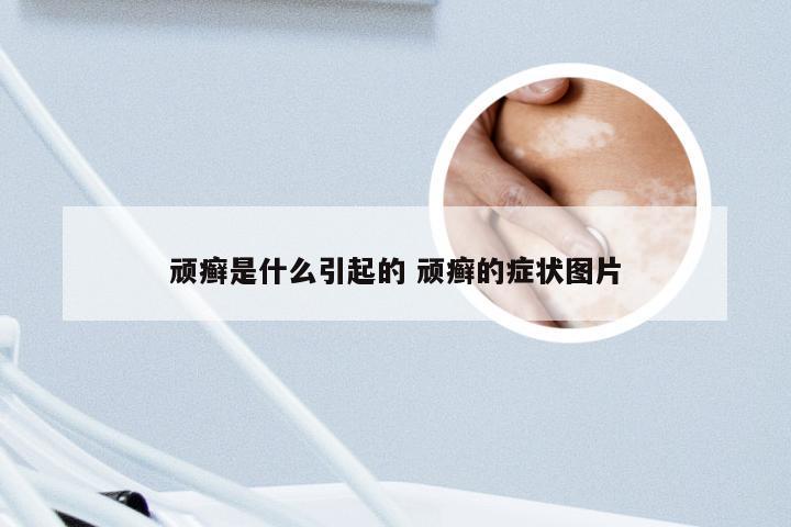 顽癣是什么引起的 顽癣的症状图片