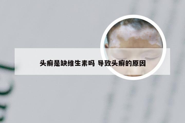 头癣是缺维生素吗 导致头癣的原因