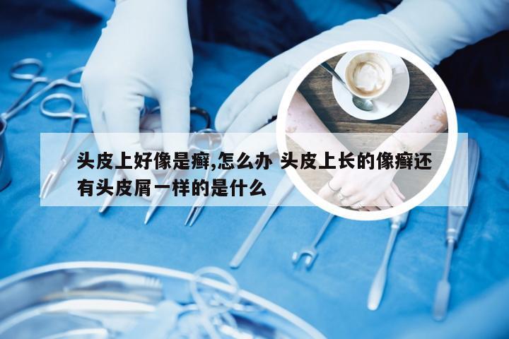 头皮上好像是癣,怎么办 头皮上长的像癣还有头皮屑一样的是什么