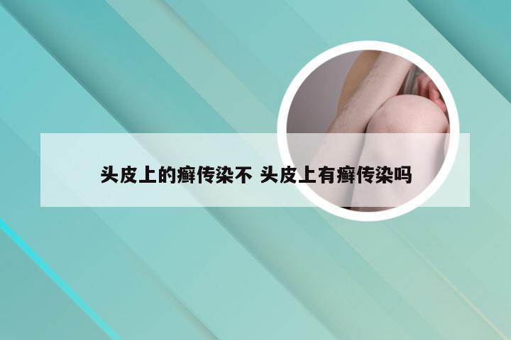 头皮上的癣传染不 头皮上有癣传染吗