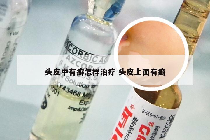 头皮中有癣怎样治疗 头皮上面有癣