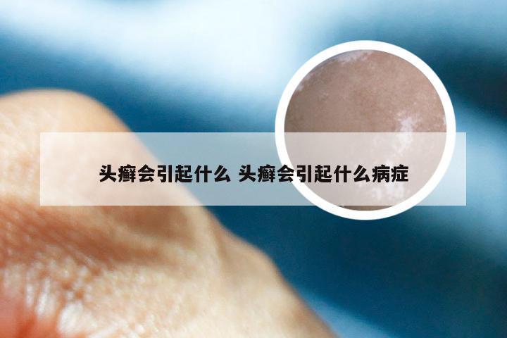 头癣会引起什么 头癣会引起什么病症