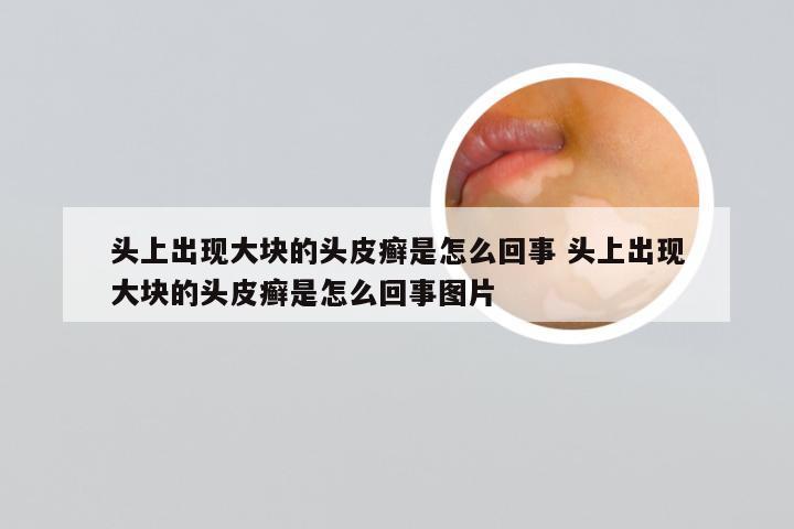 头上出现大块的头皮癣是怎么回事 头上出现大块的头皮癣是怎么回事图片