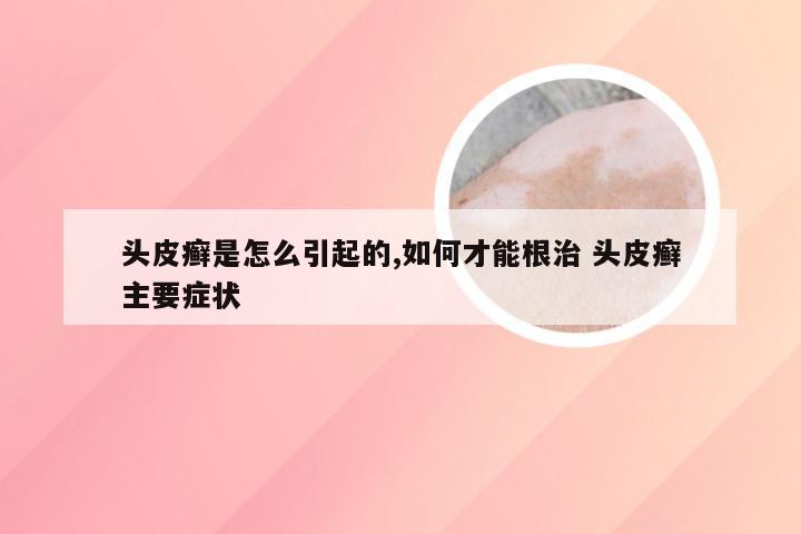 头皮癣是怎么引起的,如何才能根治 头皮癣主要症状