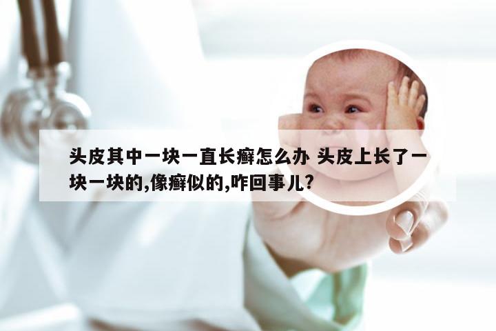 头皮其中一块一直长癣怎么办 头皮上长了一块一块的,像癣似的,咋回事儿?