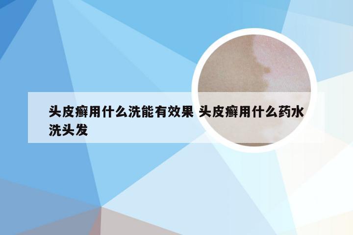 头皮癣用什么洗能有效果 头皮癣用什么药水洗头发