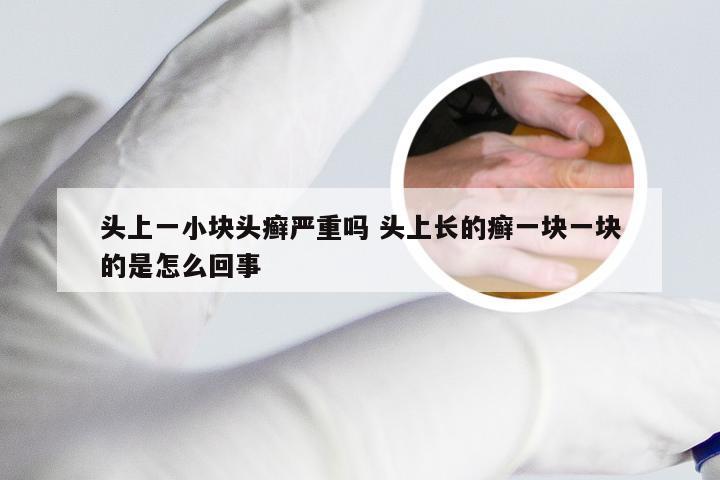 头上一小块头癣严重吗 头上长的癣一块一块的是怎么回事