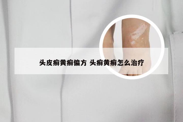 头皮癣黄癣偏方 头癣黄癣怎么治疗