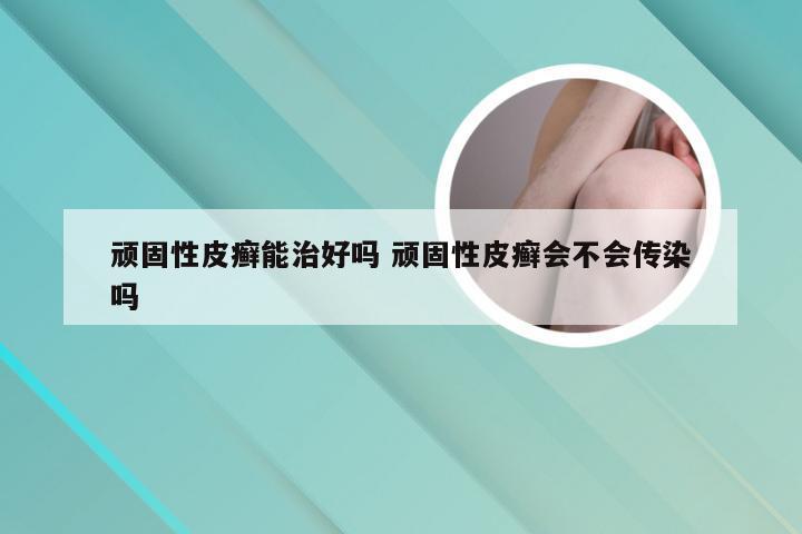 顽固性皮癣能治好吗 顽固性皮癣会不会传染吗