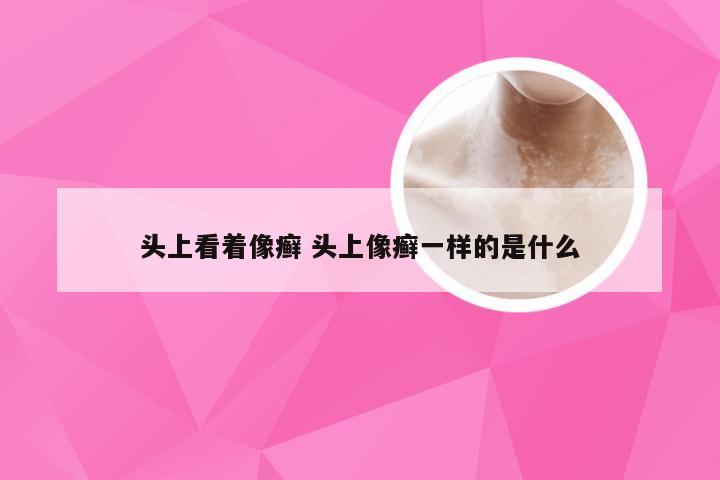 头上看着像癣 头上像癣一样的是什么