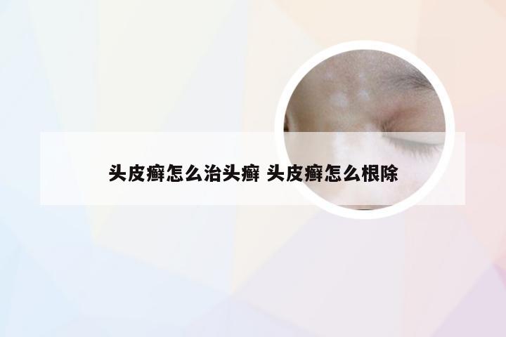 头皮癣怎么治头癣 头皮癣怎么根除