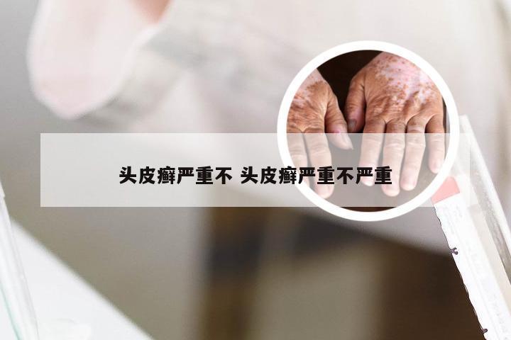 头皮癣严重不 头皮癣严重不严重