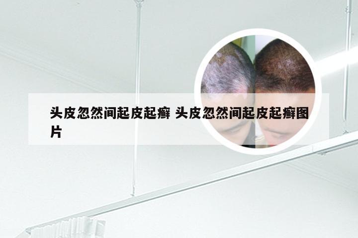 头皮忽然间起皮起癣 头皮忽然间起皮起癣图片