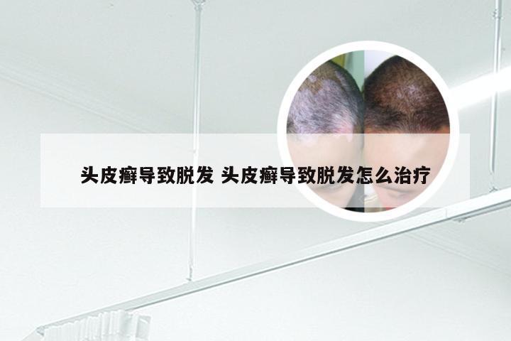 头皮癣导致脱发 头皮癣导致脱发怎么治疗