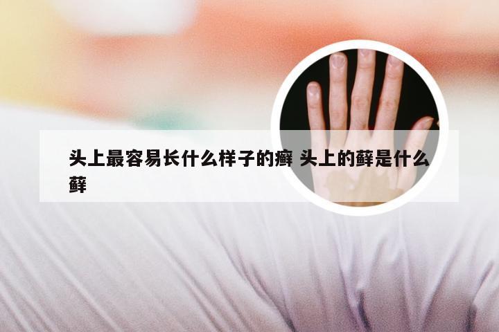 头上最容易长什么样子的癣 头上的藓是什么藓