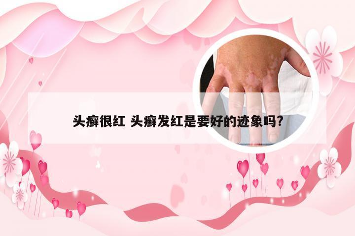头癣很红 头癣发红是要好的迹象吗?