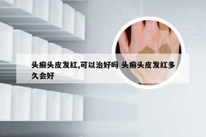 头癣头皮发红,可以治好吗 头癣头皮发红多久会好