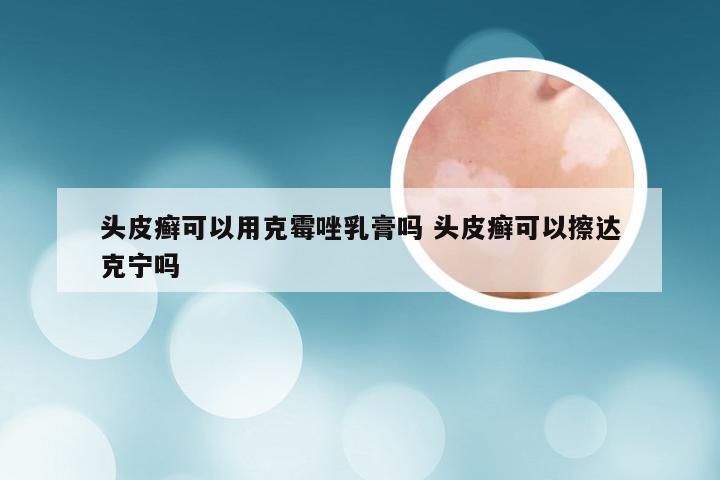 头皮癣可以用克霉唑乳膏吗 头皮癣可以擦达克宁吗