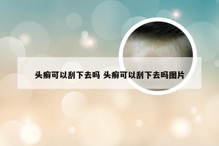 头癣可以刮下去吗 头癣可以刮下去吗图片
