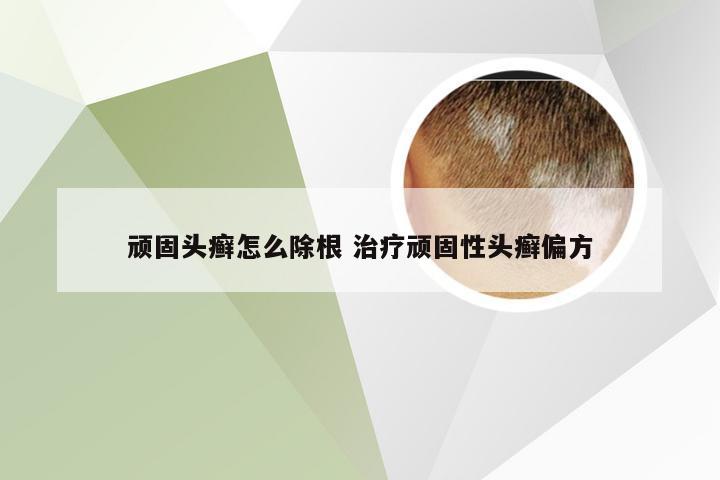 顽固头癣怎么除根 治疗顽固性头癣偏方