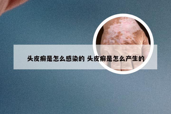 头皮癣是怎么感染的 头皮癣是怎么产生的